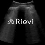 Akciğer Ultrasonunun Yorumlanmasında Yapay Zeka – Sağlık Teknoloji Haberleri